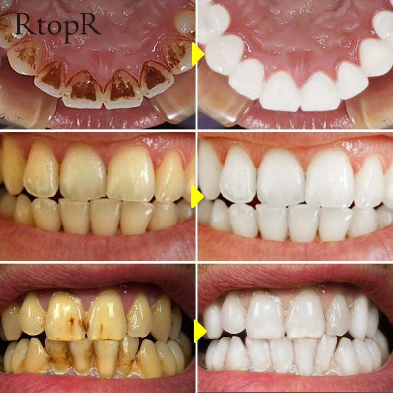 Clareamento dos Dentes com Essência natural(Tratamento para dentes amarelos,café, fumo)